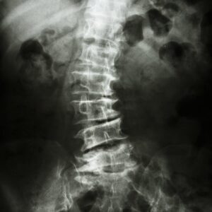 Is chiropractic safe for scoliosis?